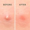 Rael Beauty Miracle Patch Invisible Acne Pimple 96 Mixta Día/noche