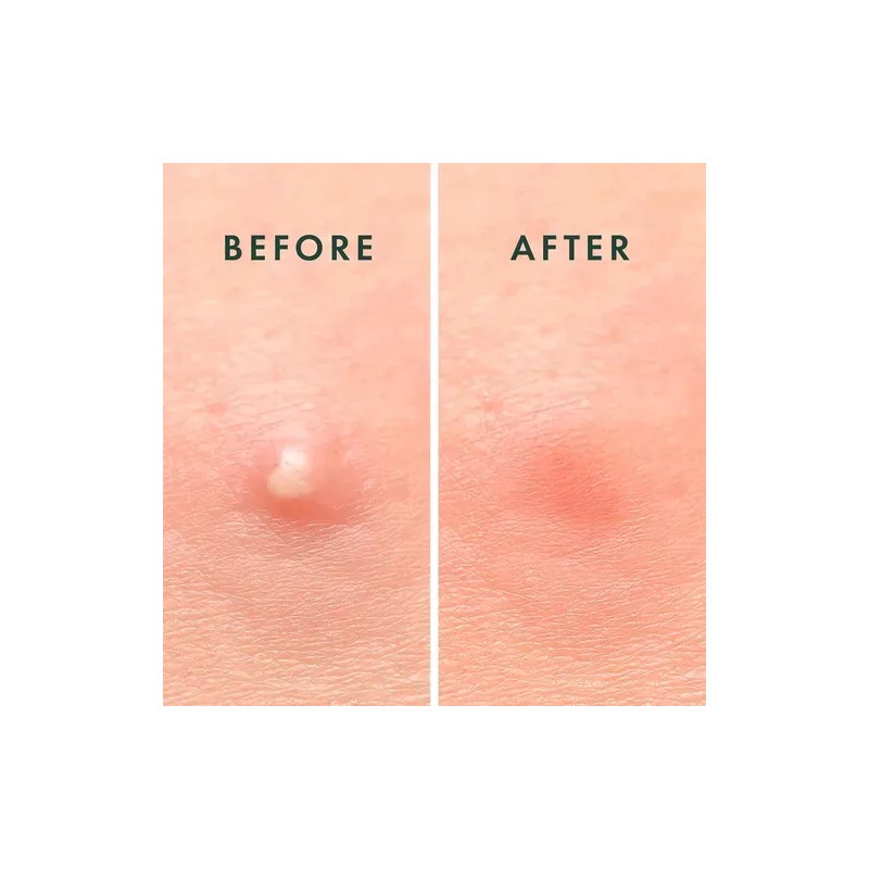 Rael Beauty Miracle Patch Invisible Acne Pimple 96 Mixta Día/noche