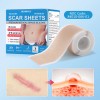 DERMFREE 6x Silicone Scar Sheets Gel Scar Patch Self-Adhesive Scar