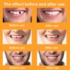 Whitening of Upper and Lower Teeth, Coverage of Tooth Stains,