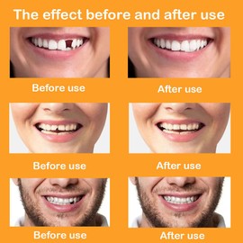 Whitening of Upper and Lower Teeth, Coverage of Tooth Stains, Teeth Restoration and whitening Solutions, Ideal Choice for a Perfect Smile, Suitable for Restoration and Stain Removal.