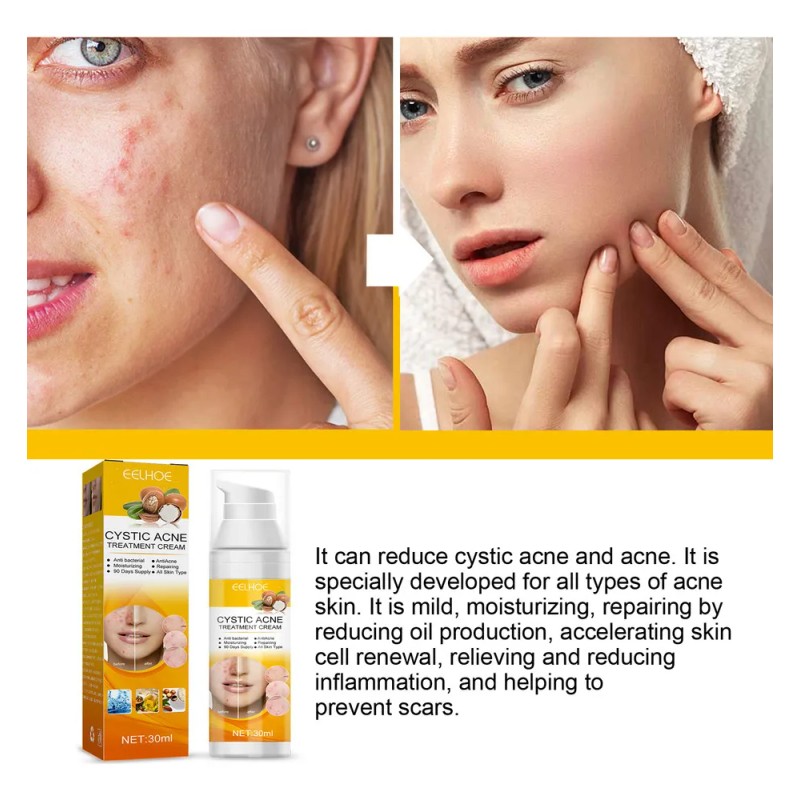 3×crema Para Tratar El Acné: Combate Acné Hormonal Quístico