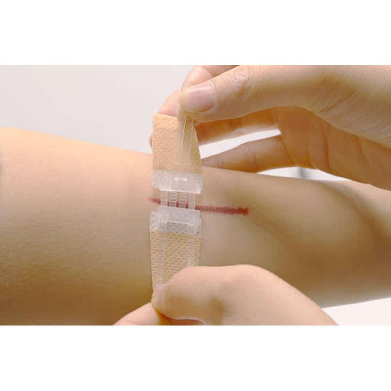 Laceration Wound Closure Device, Emergency Laceration Closure Strips to Repair