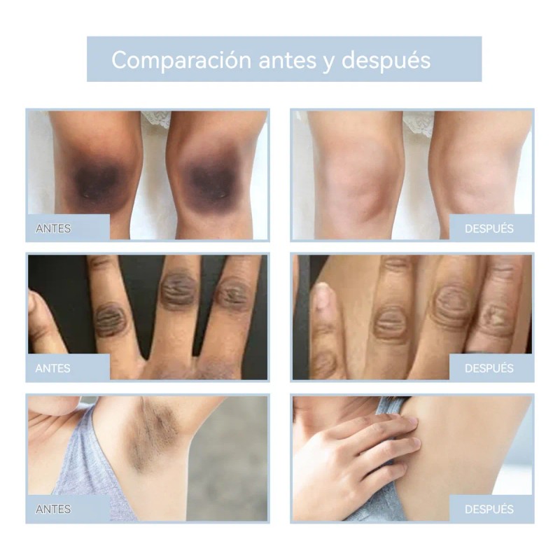 Ch Crema For Acantosis Y Melasma 50ml 1pcs .1