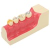 Right Lower Posterior Tooth Model 2X Magnification Detachable Resin Tooth