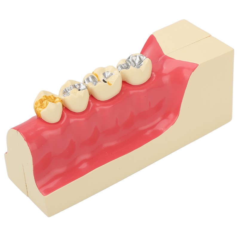 Right Lower Posterior Tooth Model 2X Magnification Detachable Resin Tooth