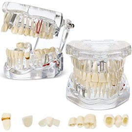 2 Modelos de Dientes de Enfermedad de Implante Dental Tipodonto con Dientes Removibles Demostración Patológica del Diente Estándar de Dentista para Educación para Auxiliares Dentales (Transparente)