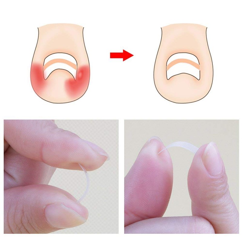 Ingrown Toenail Pedicure Tool 10pcs/bottle Straightening Clip Curved BS Brace