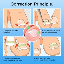 Titanium Alloy Silicone Ingrown Correction Patch Tool,Ingrown Toenail Treatment,Ingrown Toenail Removal Kit,Designed for Curved Nail Repair,Ingrown Toenail Corrector,Applicable to most sizes