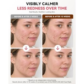 Máscara Facial de Terapia de Luz Roja y Azul para Acné y Arrugas, Máscara LED Facial con 432 LEDs y Cobertura Completa, 3 Modos de Luz para Cuidado Fa