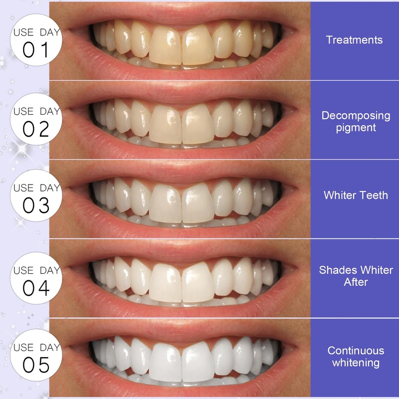 Teeth Whitening Strips Bleaching Teeth, Whitening Teeth Strips, Effective and