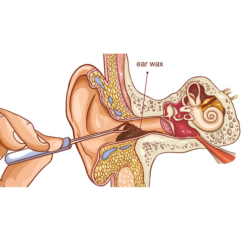 Remos ear cleaner for hygienic removal of earwax