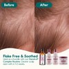 Nature Spell Dandruff Complex Shampoo & Conditioner Set, 300ml Each