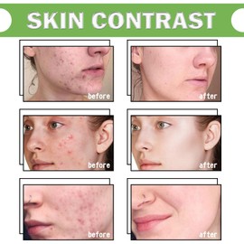 Acid 12% Facial Serum Cream,Face Serum for Women,Acid Face Cream,Acne Treatment Cream,Spot Treat-ment,Soothes Redness Balances Oil,Facial Moisturiser,Skinoren Cre-am,Night Cre-am,Acne Scar Treat-ment