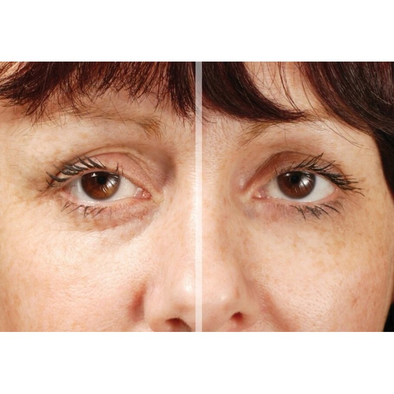 RX Ojos Impecables - COMPRA UNO CONSIGUE LA MITAD DEL