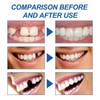 Temporary Filling Repair Kit - Fix Broken or Missing Teeth,