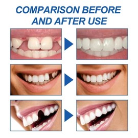 Temporary Filling Repair Kit - Fix Broken or Missing Teeth, Bridge Gaps, Replace Chipped Teeth with False Teeth and Fillers