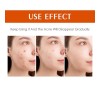 Tamoskiny Acne Face Blemish Pimple Cream Salicylic Cystic Breakout Treatment
