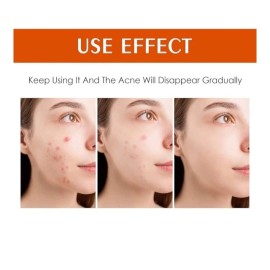 Tamoskiny Acne Face Blemish Pimple Cream  Salicylic Cystic Breakout Treatment