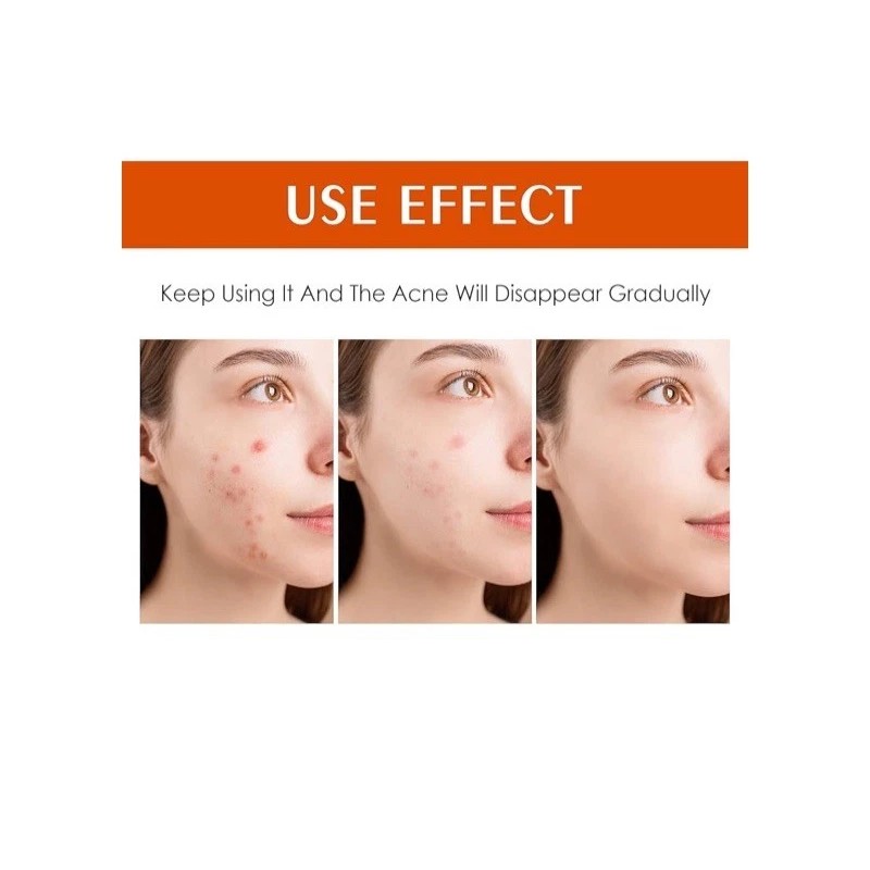 Tamoskiny Acne Face Blemish Pimple Cream Salicylic Cystic Breakout Treatment