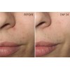 Niacinamide 10% +Zink 1% +Hyaluronic Acid | Acne/Blemish/Oil Control Serum/Cream