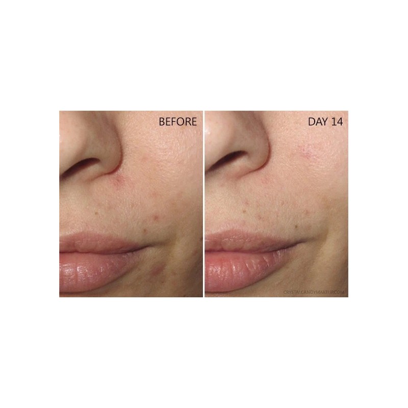 Niacinamide 10% +Zink 1% +Hyaluronic Acid | Acne/Blemish/Oil Control Serum/Cream