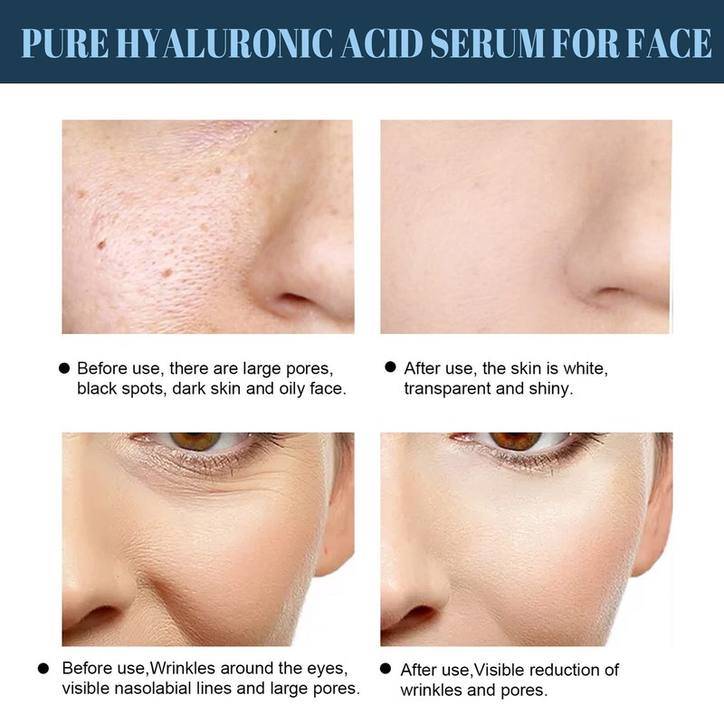 Face Lifting, Collagen Silk Threads, Collagen Silk Threads for Lifting,