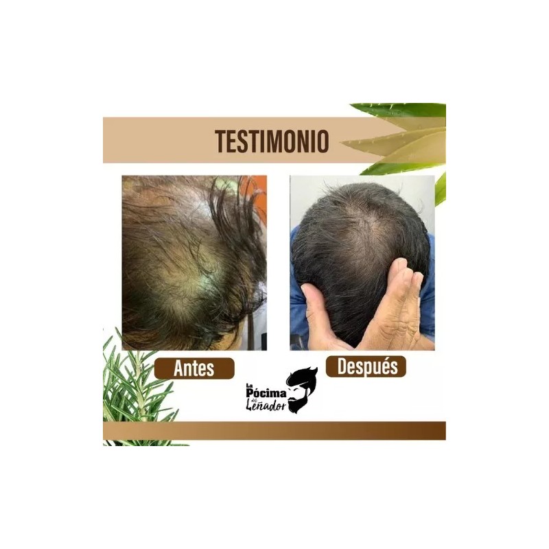 pócima de Rapunzel Kit Rapunzel Pócima Del Leñador, Anticaída Y