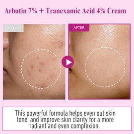 Arbutin 7% + Tranexamic Acid 4% Cream, Dark Spot Corrector Face Cream for Women, Skin Brightening Korean Moisturiser, Anti Aging Hydrating Cream for Pigmentation, Freckles, Blemishes, Glass Skin Glow