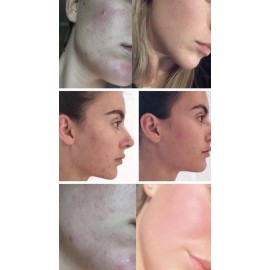 Nu Skin 180 AHA Facial Peel & Neutralizer Anti-Aging 2-Steps 18 Pads | NuSkin