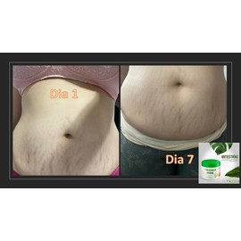 Derma Max Gel Antiestrias, Hidratante 120 g (4 oz) Hidrata y Nutre la piel Ayudando a Prevenir la Aparicion de Estrias Hecho con componentes