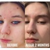 Niacinamide 10% +Zink 1% +Hyaluronic Acid | Acne/Blemish/Oil Control Serum/Cream