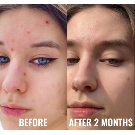 Niacinamide 10% +Zink 1% +Hyaluronic Acid | Acne/Blemish/Oil Control Serum/Cream