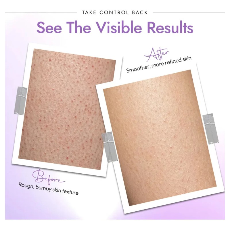 Bump Eraser Body Scrub With 10% Ahas + Phas For