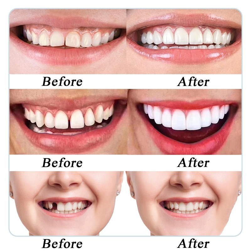 False Teeth Veneers Top and Bottom,Veneers Teeth,Clip on Veneers Top