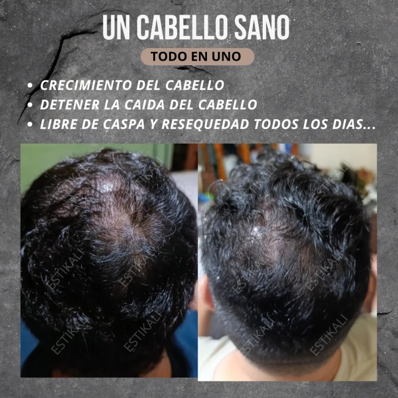 Shampoo Anticaída Anticaspa Antigraso Crecimiento De Cabello