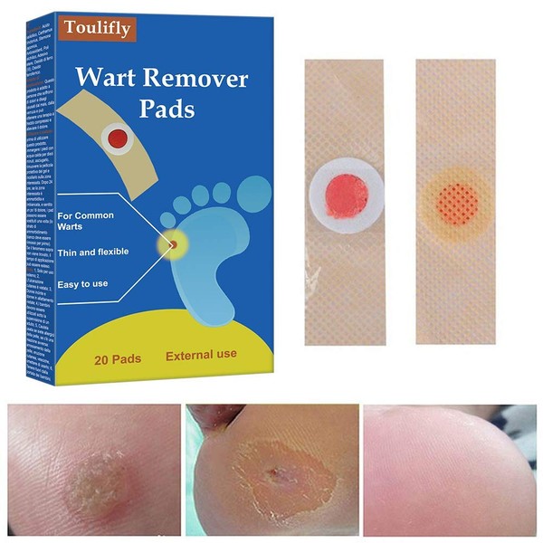 Wart Remover,Corn Remover,Foot Corn Remover Pads,Plantar Wart Removal, Corn Callus Remover, Penetrates and Removes Common and Plantar Warts, Callus,Stops Wart Regrowth,20PC