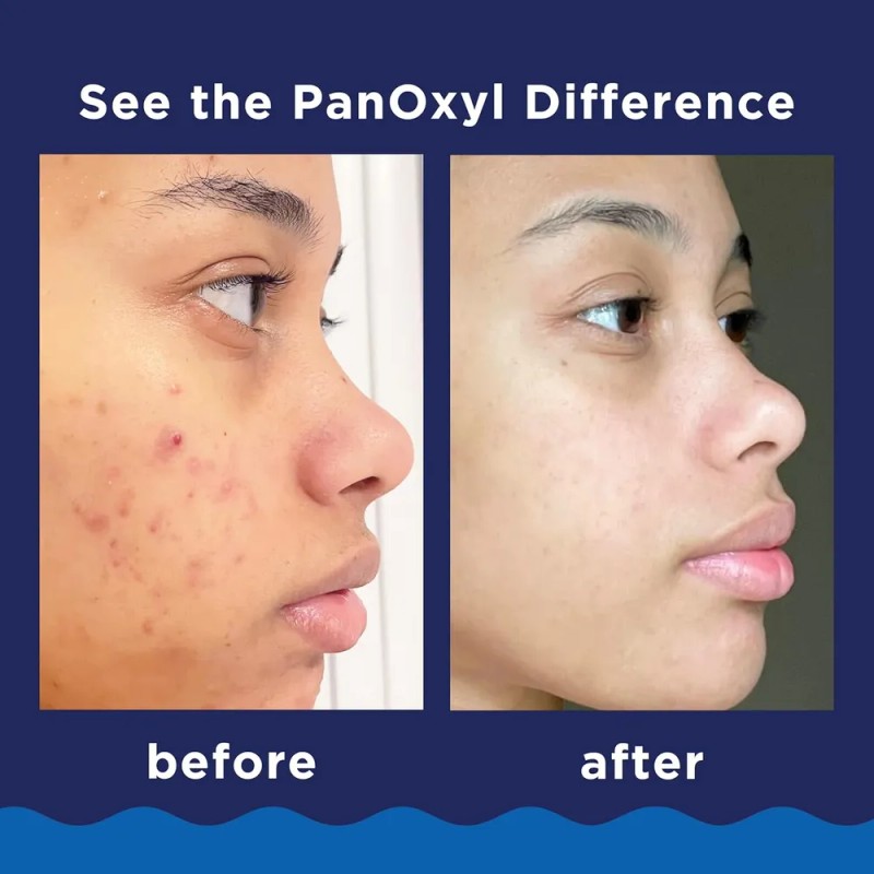 Panoxyl Lavado De Espuma Para Acné Peróxido De Benzoilo 10%