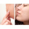 Tea Tree Acné Pimple Parche, 44 Parches De Absorbente Para