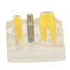 Teeth Implant Model Transparent Dental Teaching Research Demonstration Teeth Model