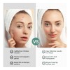 Creme De Tea Tree Oil Para Acne, Espinhas E Pele