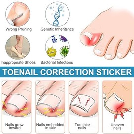 50 Piezas de Parche para Uñas Encarnadas – Soporte Natural para Uñas, Transpirable, Fácil de Aplicar Durante la Noche, Comodidad Suave para Uñas Encar