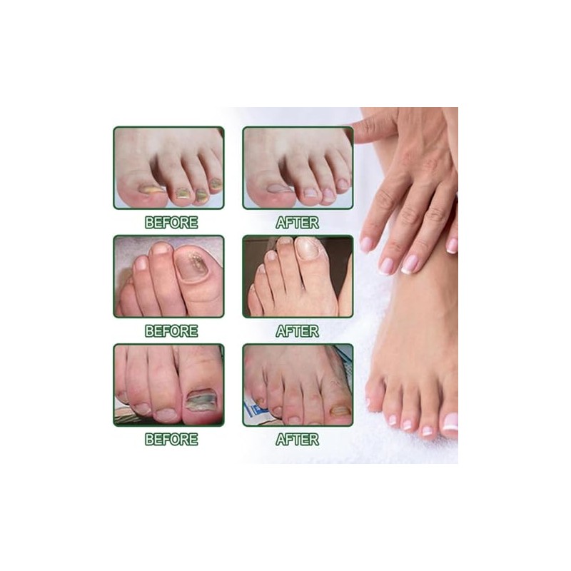 Ginger Nail Tratamiento Uñas Jengibre Soporte Cuidado Suero Crecimiento Aceite