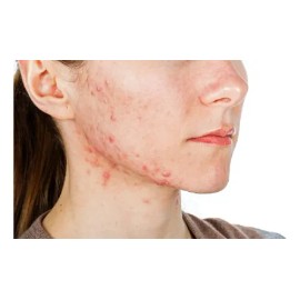 Treeactiv Crema Facial Acné Tratamiento Natural Promoción 3x