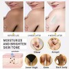 Adecuado Para Manchas, Cloasma Y Acné. Crema Antipecas.
