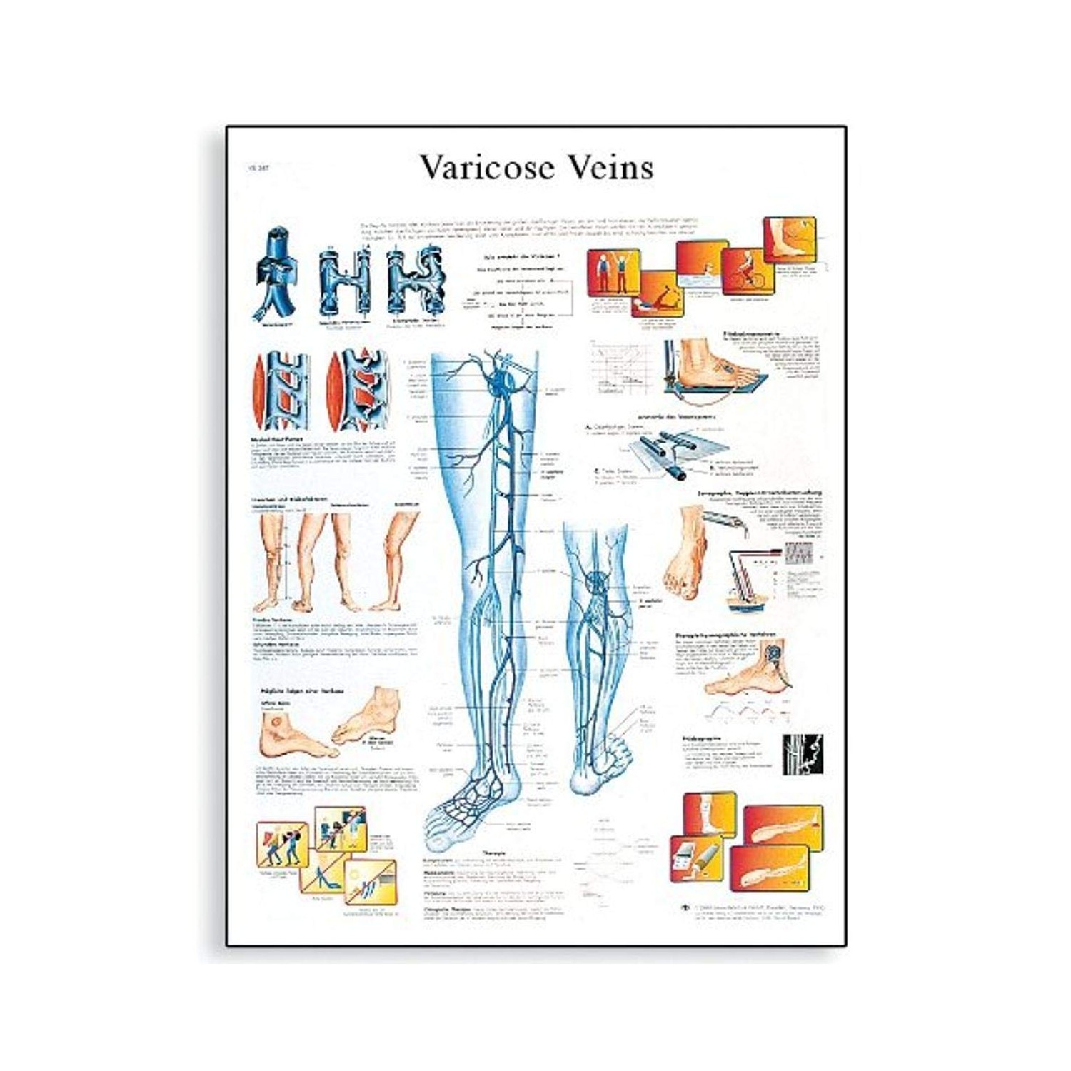 3B Scientific VR1367L Glossy Laminated Paper Varicose Veins Anatomical ...