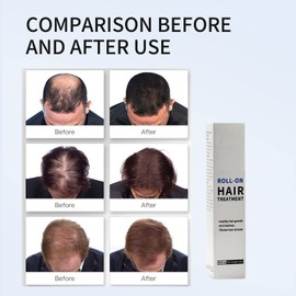 Roll-on Hair Treatment, Hair Growth Serum, Hair Growth Serum, Roll-on Hair Treatment, Hair Growth Serum for Dry Hair, Curly Hair, Hair Loss Damaged Hair and Hair Growth
