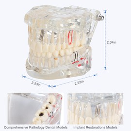 Healthible - Modelo de dientes de implante dental transparente - Modelo de dientes de implante de educación dental modelo de dientes de enfermedad transparente modelo de dientes patológicos con dientes extraíbles