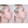 Fast-Acting Acne Scar Treatment Cream - 24-Hour Spot Reduction, Anti-Acne