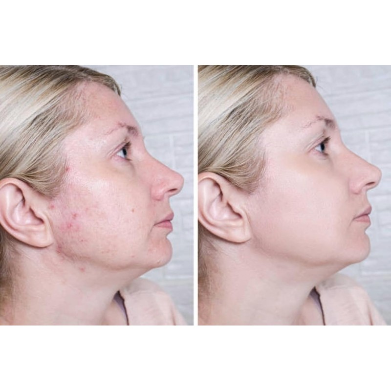 Fast-Acting Acne Scar Treatment Cream - 24-Hour Spot Reduction, Anti-Acne